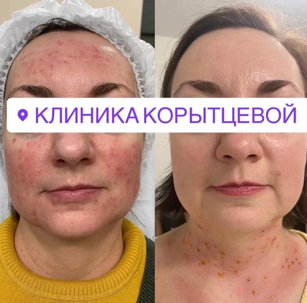 Результат пациентки до/после Endoret®(PRGF)