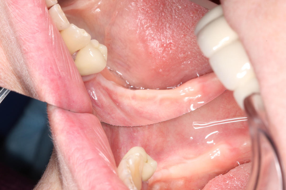 Сохранена тонкая полоска плотной десны на вершине, дальше – тяжи слизистой.