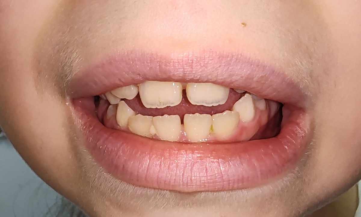 Открытый прикус. Зубы не смыкаются. 