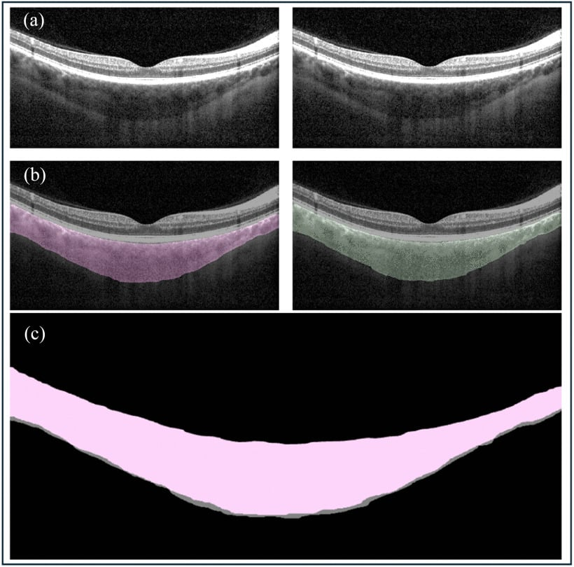 Сканирование глазного дна — космос влияет на форму и структуру сетчатки, вызывая отёки и изменения, заметные на МРТ и ОСТ-снимках.
