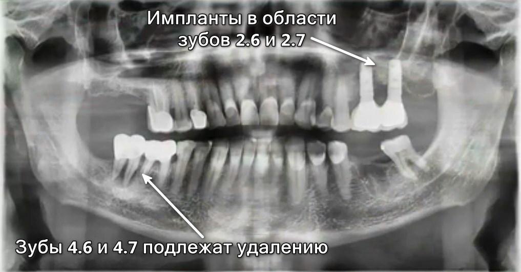 Зубы пациента до начала лечения