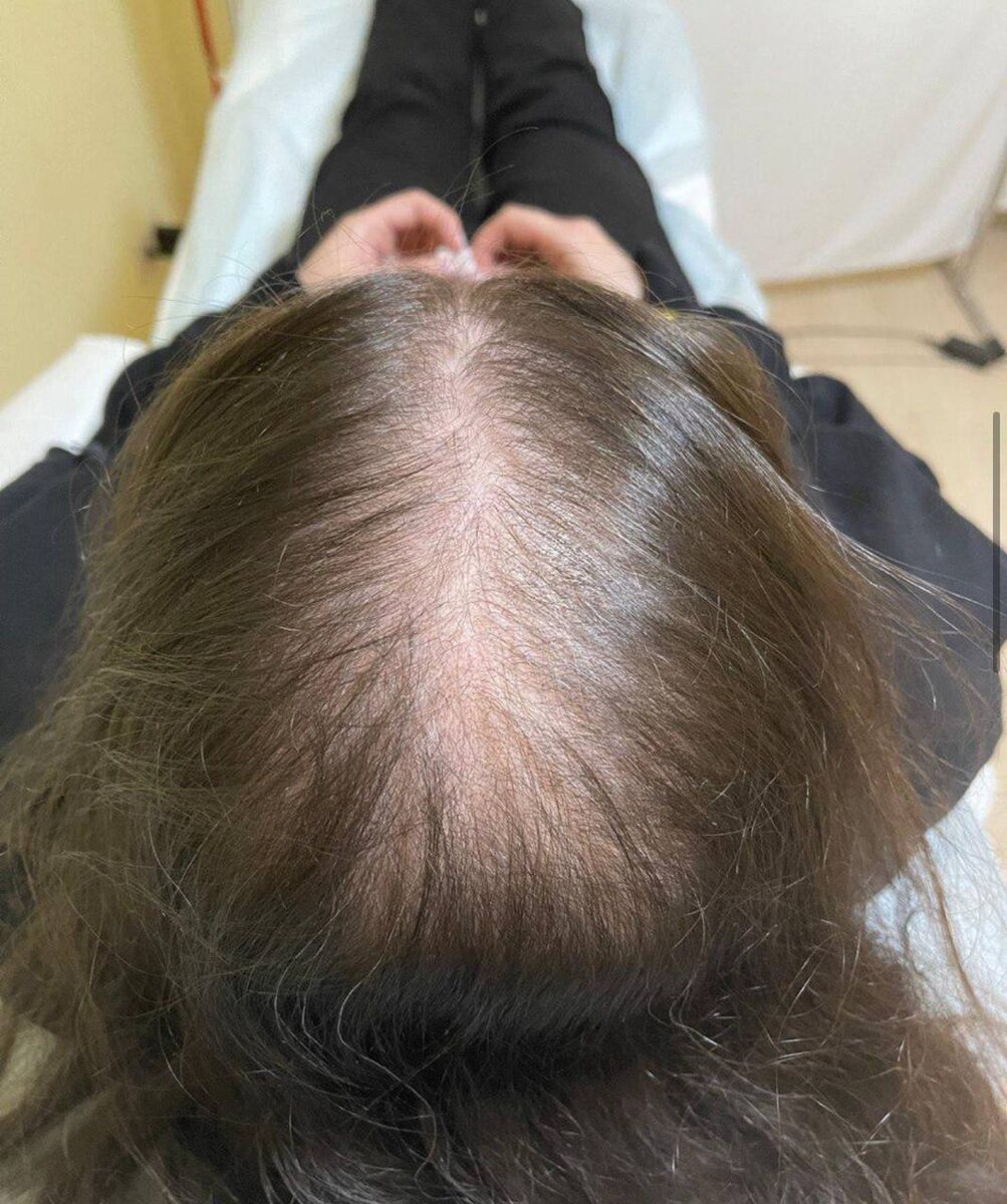 Пациентка до начала терапии НеТЛАП