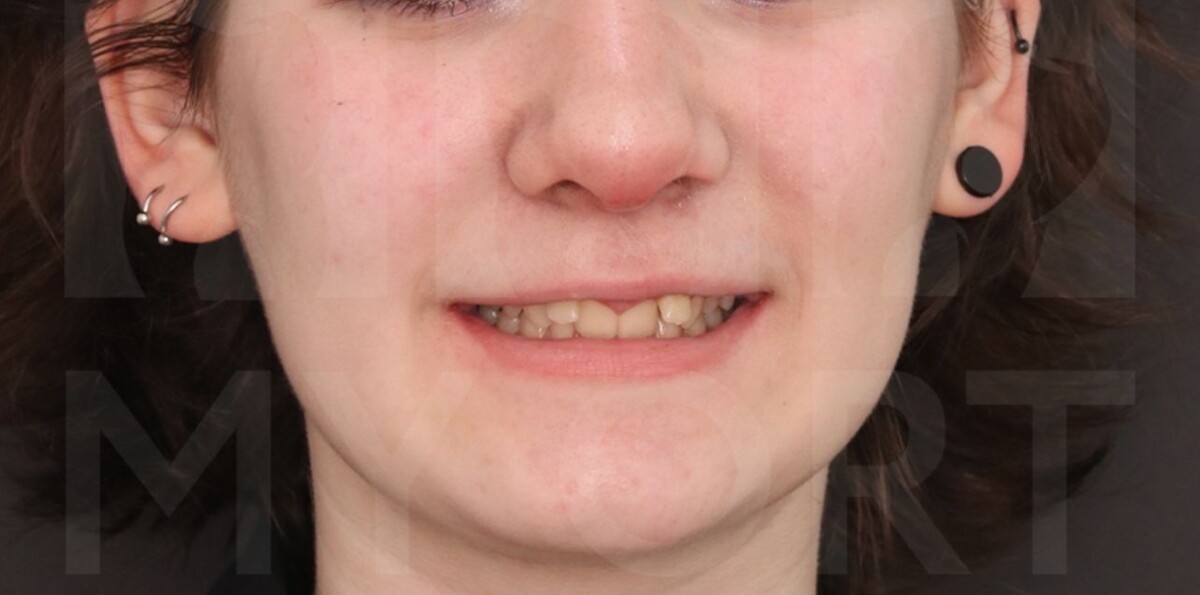 улыбка пациентки до ортодонтического лечения