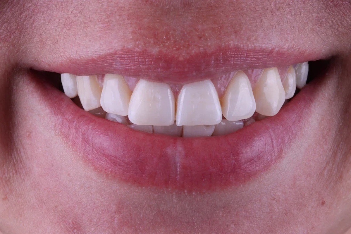 Композитные виниры — быстрый, но не долгосрочный результат. 