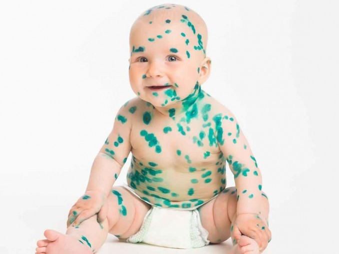 Если ветрянка у ребёнка протекает тяжело – много гнойничков, корок и они сильно зудят: помощь малышу