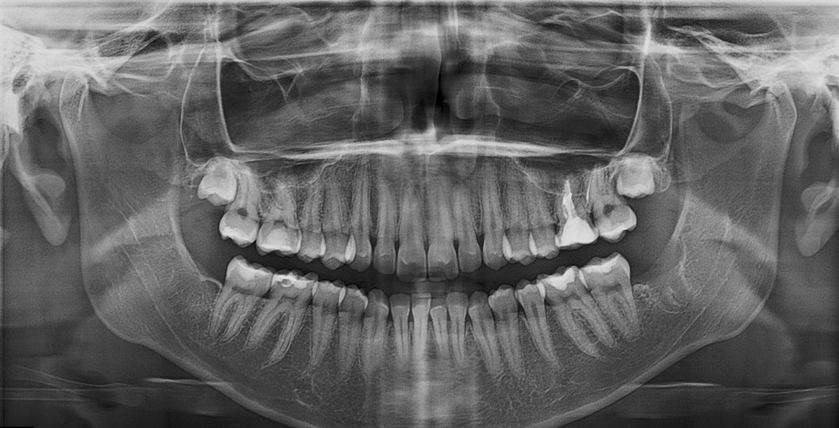 Пациент женщина, 2003 г.р., зуб 3.7 анатомия 