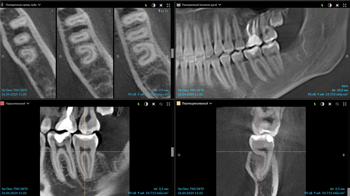 Пациент женщина, 2003 г.р., зуб 3.7 анатомия 