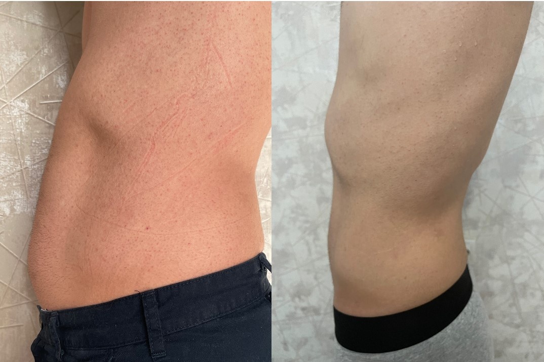 Результать после 3-х процедур липолитиков