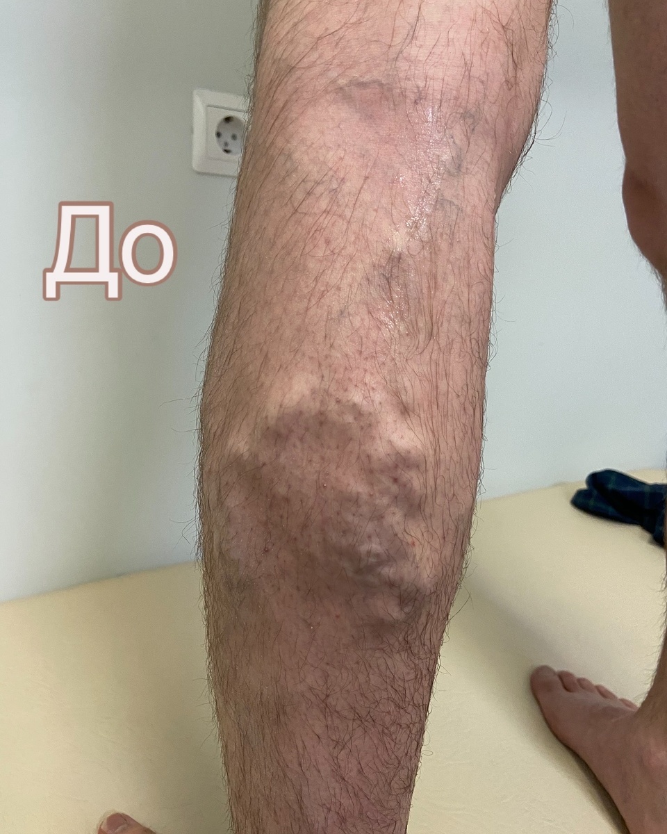 До ЭВЛО МПВ и минифлебэктомии