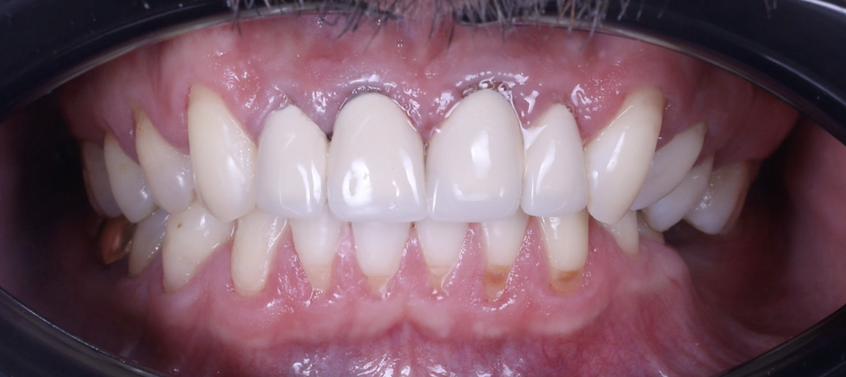 Начало лечения