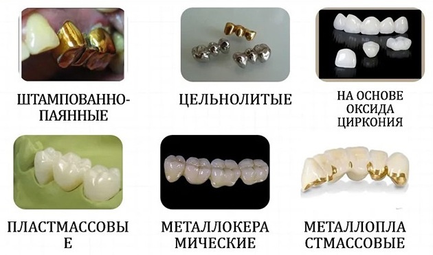 Виды зубных мостов
