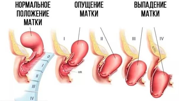 Степени опущения матки