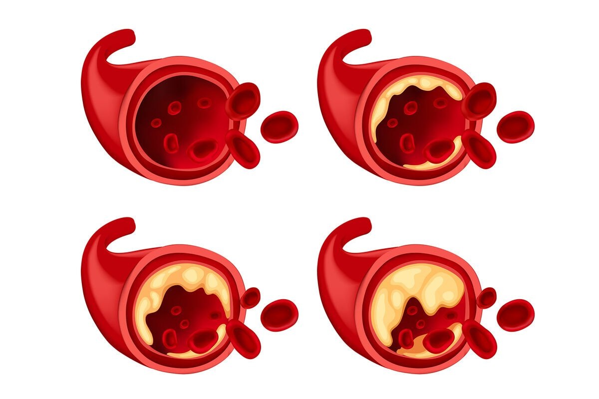    Сам по себе повышенный холестерин еще не значит, что в сосудах обязательно появятся атеросклеротические бляшки