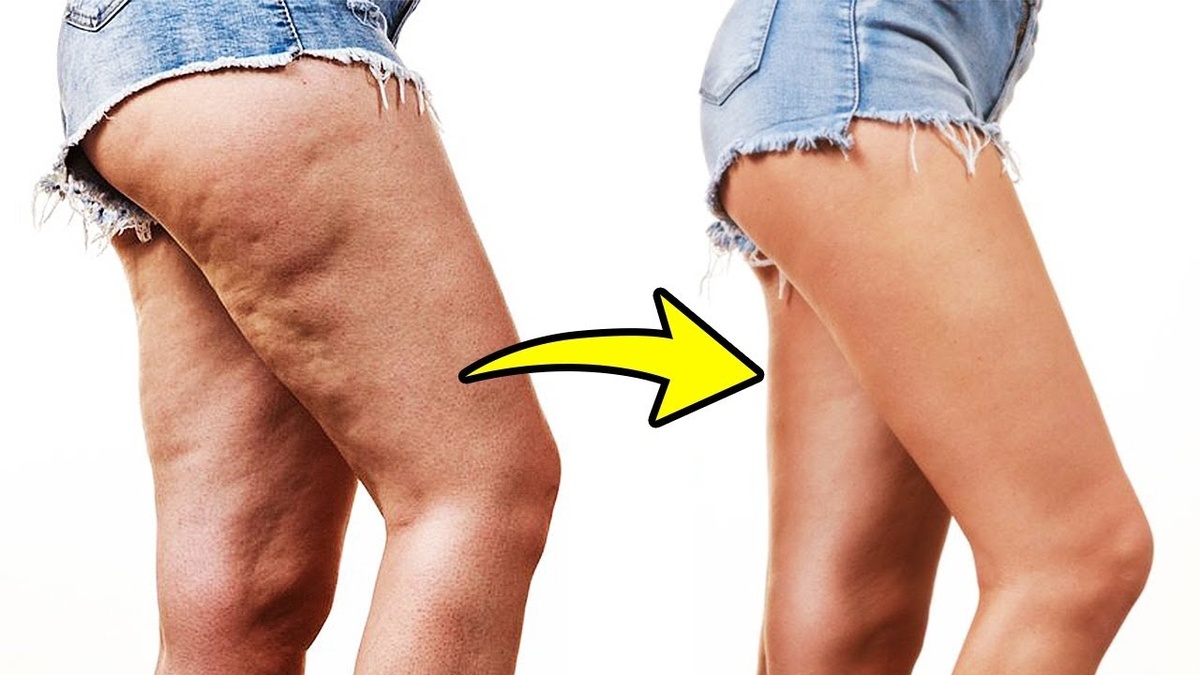 Целлюлит это не приговор