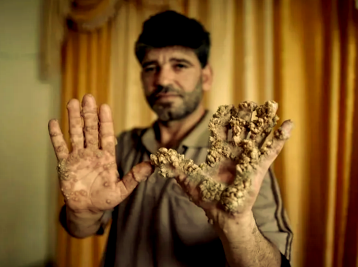 Мужчина с очень редким аутосомно-рецессивным заболеванием в достаточно сложной форме