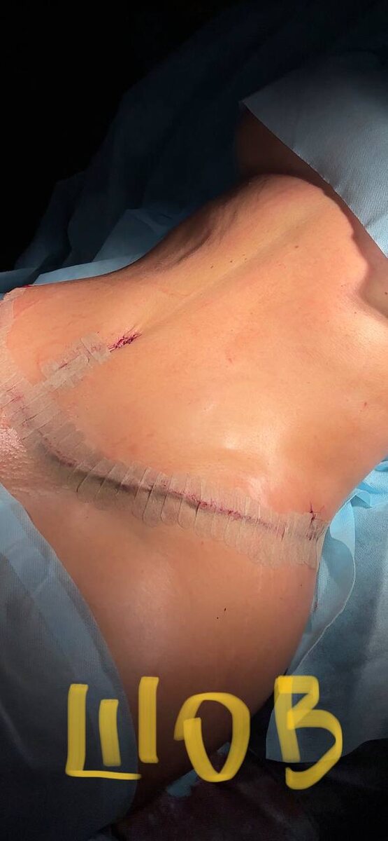 фото шва на операционном столе