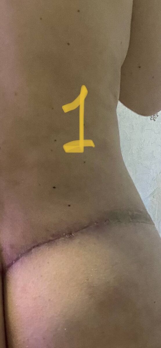 Эпителизация разреза 