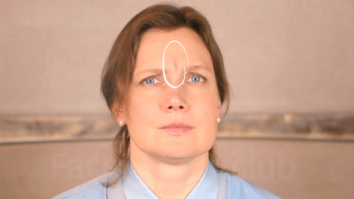 Нахмурились — появилась межбровка