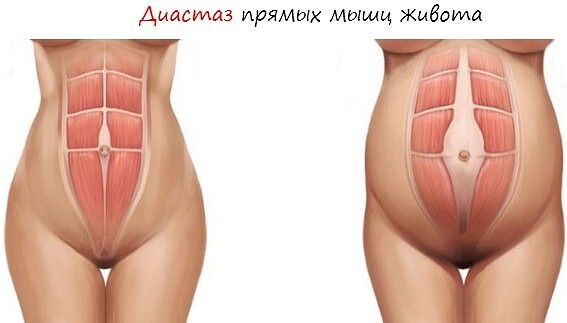 А вы знали, что от состояния мышц живота зависит не только ваш внешний вид, но и здоровье внутренних органов?