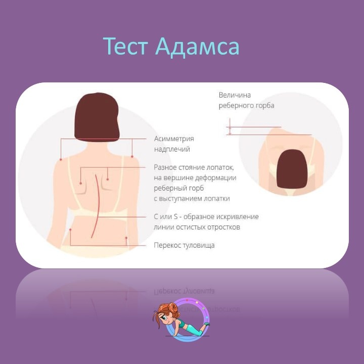 

По статистике каждый 5 ребенок имеет сколиоз. Некоторым достаточно выполнять гимнастику и носить корсет, а кому-то требуется операция.

Но, чтобы понять, требуется ли какое-либо лечение, необходимо распознать само заболевание.

Как провести тест?

Рассказал Илья Александрович Шавырин, к.м.н.,врач ортопед-вертебролог

1️⃣ Ребенок из положения стоя медленно наклоняется вперед до параллели с полом, ноги вместе, руки опущены
2️⃣ Родитель становится позади и смотрит, наблюдается ли асимметрия лопаток, плеч и линии таза

Оцениваем результаты

❗Признаки сколиоза в положении стоя:
— Разная высота плеч
— Одна лопатка выступает больше, чем вторая
— Искривление вертикальной линии позвоночника
— Перекос тазовой линии

❗Признаки сколиоза в наклоне:
— Ели смотреть сзади, то с одной из сторон можно заметить реберный горб
— Если смотреть сбоку, то наблюдается поясничный горб

Если вы увидели признаки сколиоза, рекомендуем обратиться к специалисту, который подберет правильное лечение👨‍⚕️

