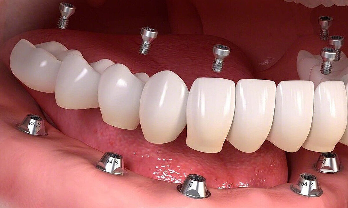 Импланты зубов