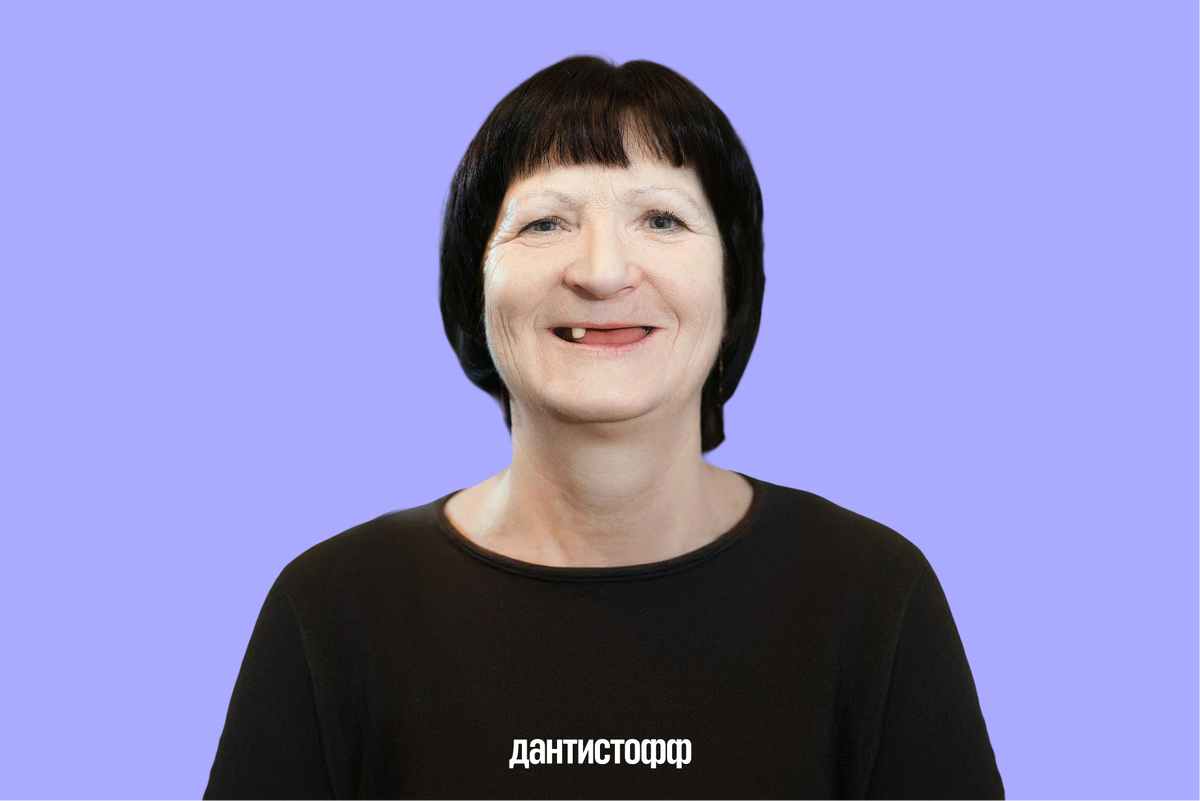 Моя улыбка до имплантации