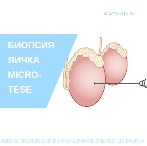 Биопсия яичка micro-TESE