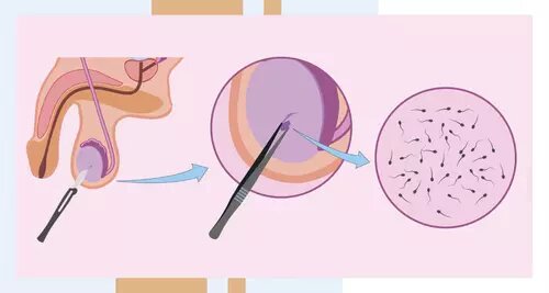 Биопсия яичка