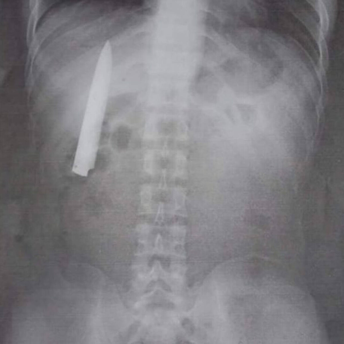 фото из интернета. Инородное тело грудной клетки.