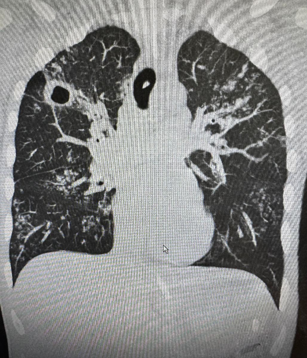 Туберкулез легких на КТ. Видна полость распада справа и многочисленные очаги уплотнения в обоих легких. 