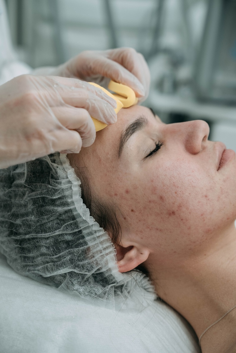 Лечение акне у косметолога в Москве 