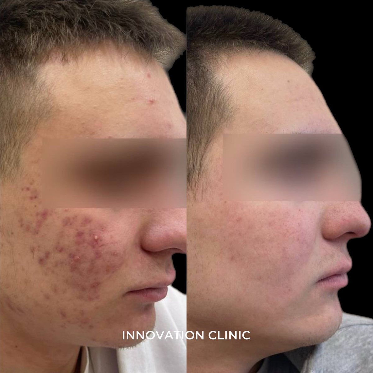 Лечение акне врач: Артавазд Чопикян