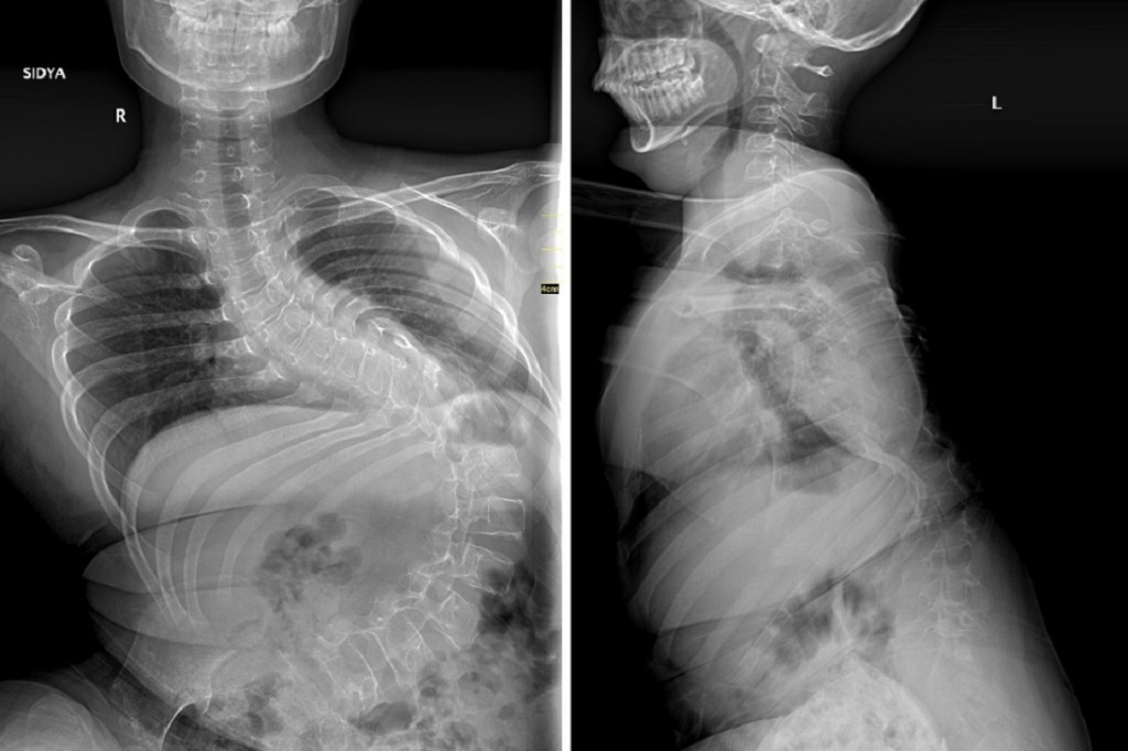 Состояние ребёнка до операции. Фото: Новосибирский НИИТО имени Я. Л. Цивьяна