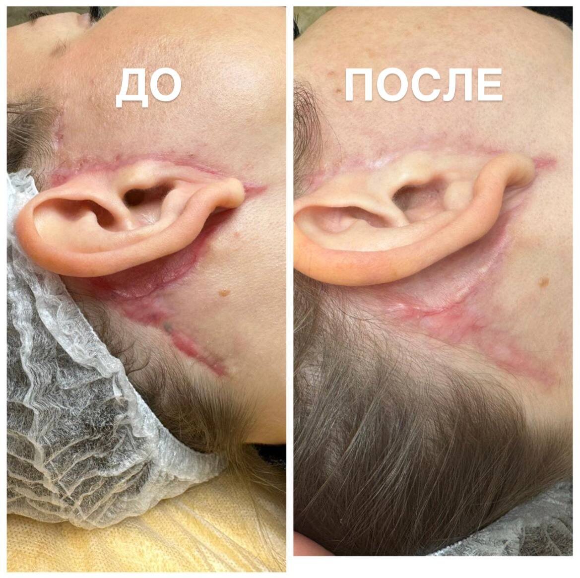 Результат спустя 1,5 мес в области правой ушной раковины