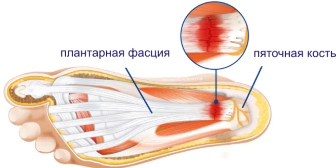 Как решить боль в пятке раз и навсегда