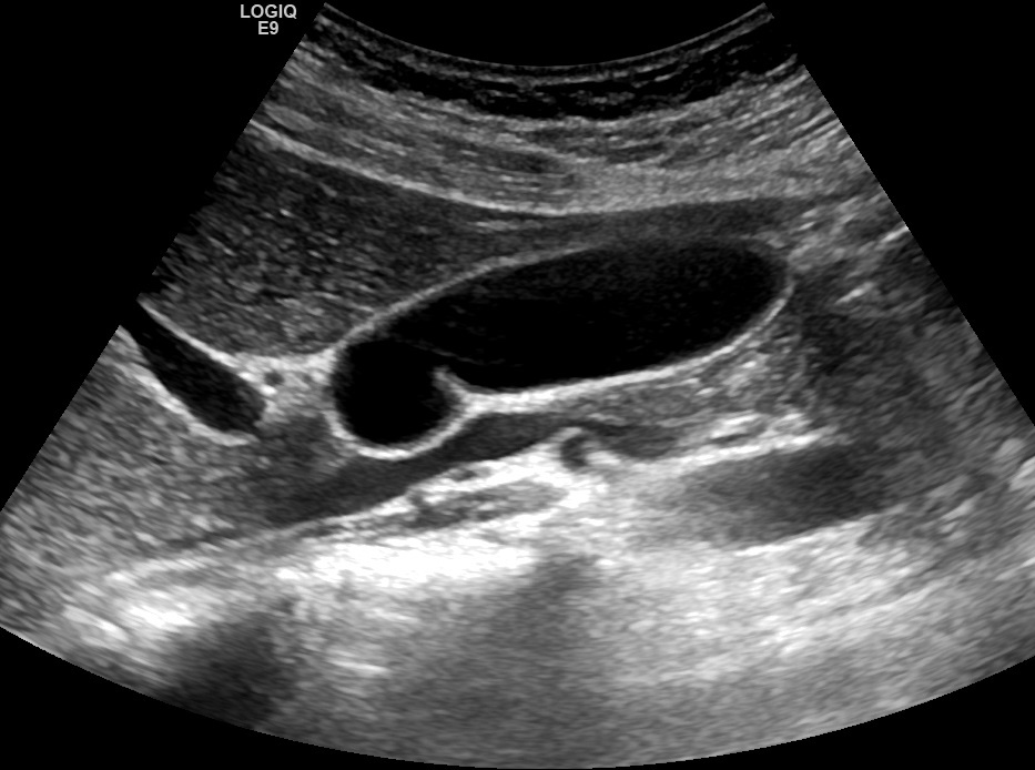 Рис. 01. Перегиб в шейке.