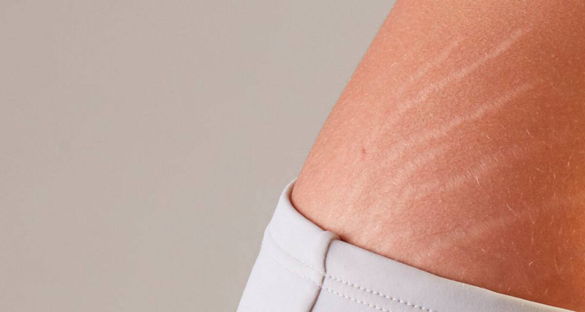 Растяжки многие воспринимают как серьезный недостаток