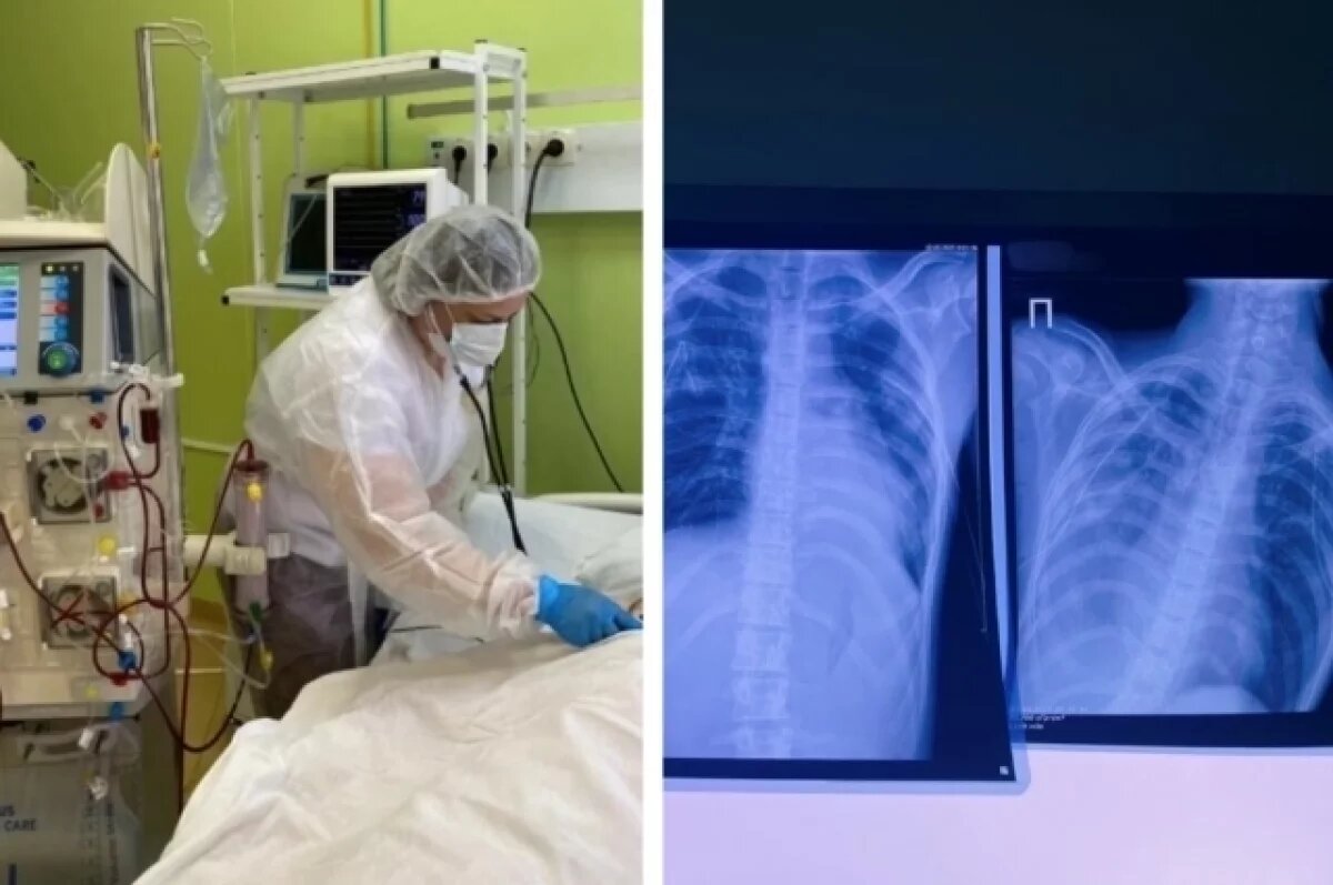    16-летние подростки из Кирова госпитализированы с тяжёлым поражением лёгких.