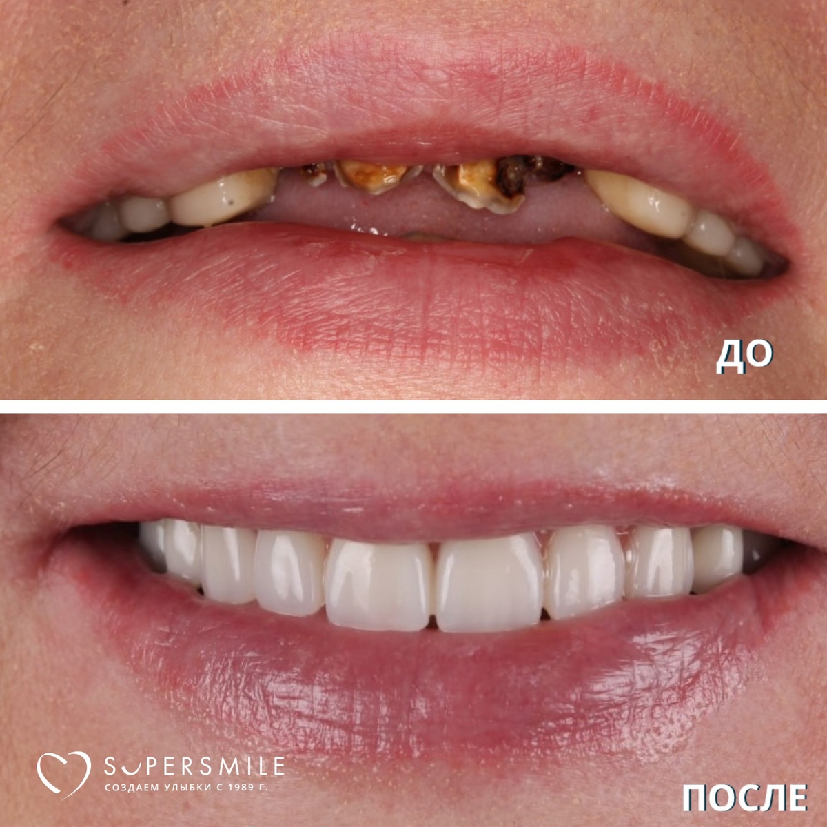 Все на 4 -  этап временного протезирования