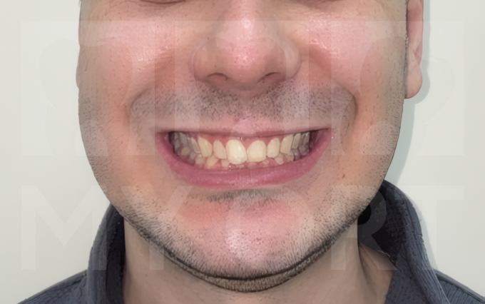 Улыбка пациента ДО лечения