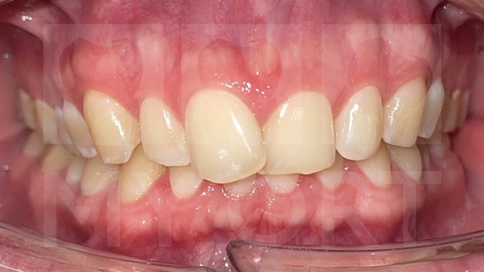 зубы в сомкнутом состоянии