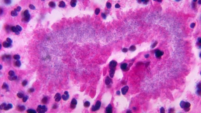    Редкая бактериальная инфекция вызывает гнойные язвы в легких и мозге