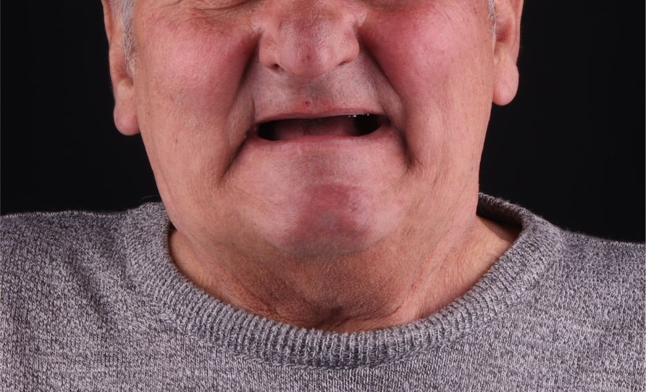 Клинический случай пациента ПРАЙМа: отсутствуют все зубы.