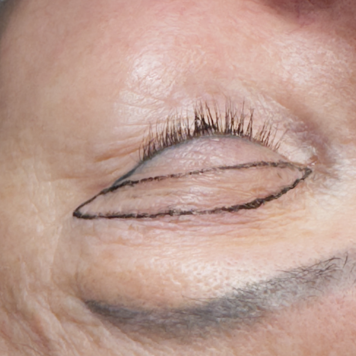 Предоперационная разметка, верхняя блефаропластика, пластический хирург Стайсупов В.Ю.