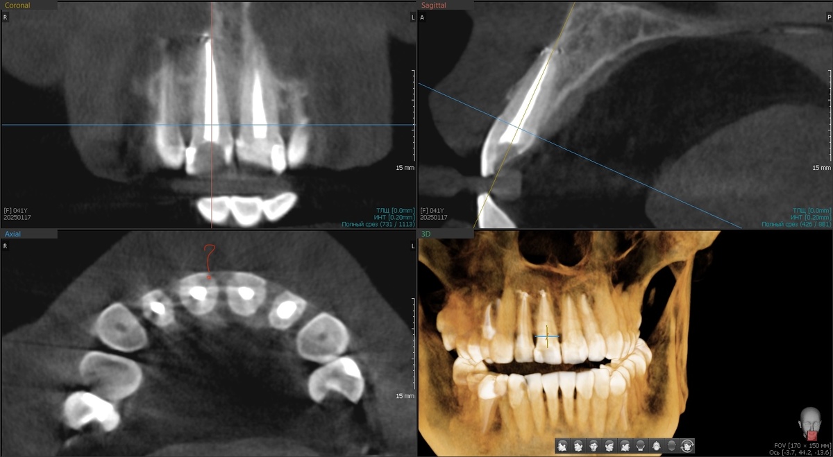 КЛКТ до попытки установить коронку