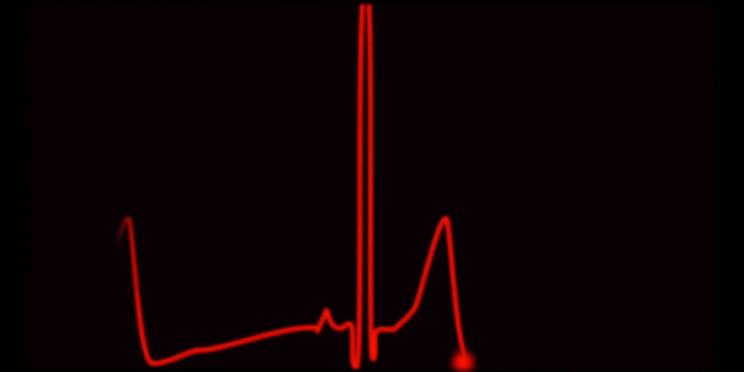 Пульс замедляется или ускоряется в состоянии покоя — это нормально?