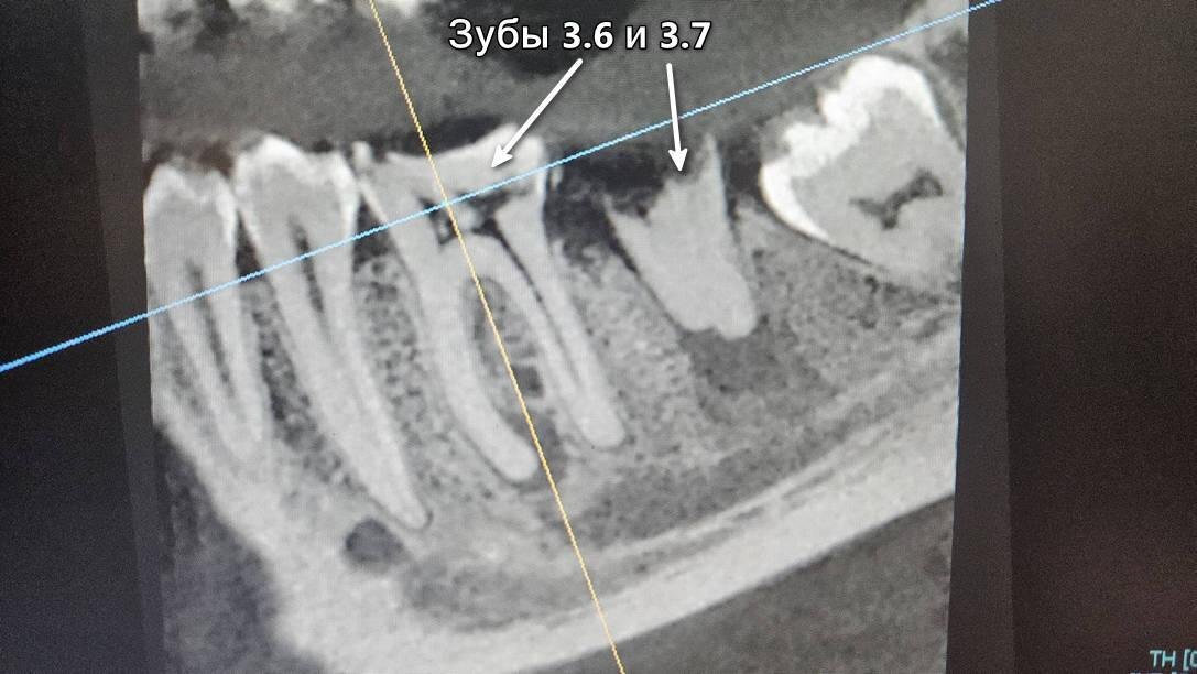 Источники острой боли: зубы 3.6 и 3.7