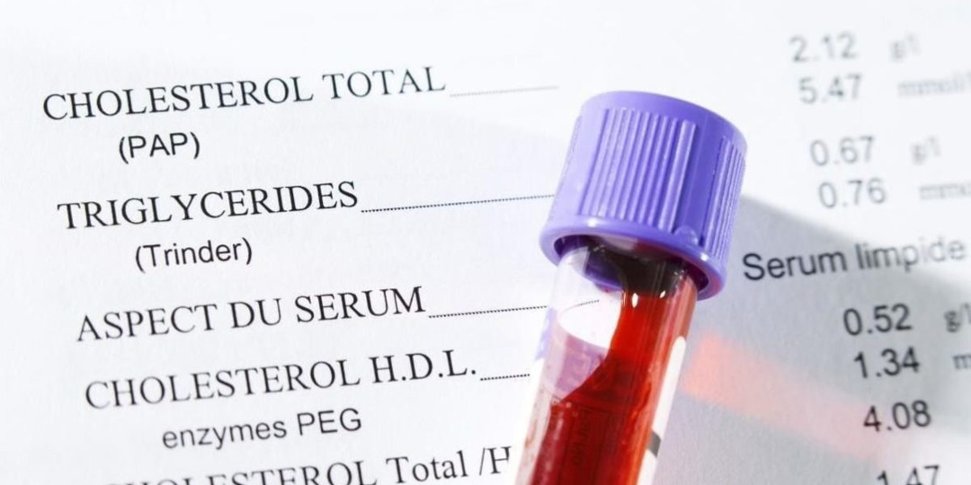 Как определить повышенный уровень холестерина: патофизиолог дала подробное руководство по анализам и не только