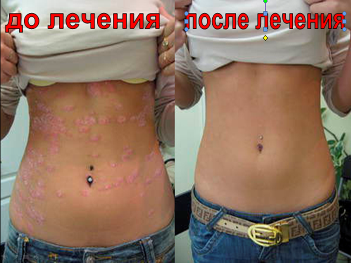 ЛЕЧЕНИЕ ПСОРИАЗА

Псориаз — сложное, коварное, но не заразное заболевание, выздоровление от которого в домашних условиях весьма сомнительно. Широкий спектр методов борьбы с псориазом предлагает санаторий «ХИМИК». Многолетний опыт показывает, что именно здесь достигаются лучшие результаты, чем при медикаментозной терапии. В нашей здравнице есть свои программы, направленные на увеличение длительности ремиссии, так как на сегодняшний день эта болезнь считается неизлечимой. Если появилась необходимость на долгое время избавиться от нее, можно узнать в санатории «ХИМИК»,  какие методы воздействия на кожные покровы и организм в целом практикуются в каждом из них, какова стоимость пребывания можно узнать в отделе маркетинга и бронирования.
САНАТОРИЙ «ХИМИК» расположен в 100 метрах от берега знаменитого своими лечебными иловыми грязями  озера Большое Яровое. Оно находится в небольшом курортном городке Яровое в 8-ми километрах от г.Славгорода. О лечебных свойствах яровских грязей известно с давних времен. Бальнеологические процедуры, практикующиеся в этом санатории, способствуют исчезновению симптомов псориаза и вызывают длительную ремиссию у 98% процентов больных. Такой эффект достигается благодаря тому, что местные грязи обладают противовоспалительным и болеутоляющим эффектом, они хорошо прогревают кожные покровы и улучшают в них циркуляцию крови, насыщают организм целебными веществами органического происхождения.

