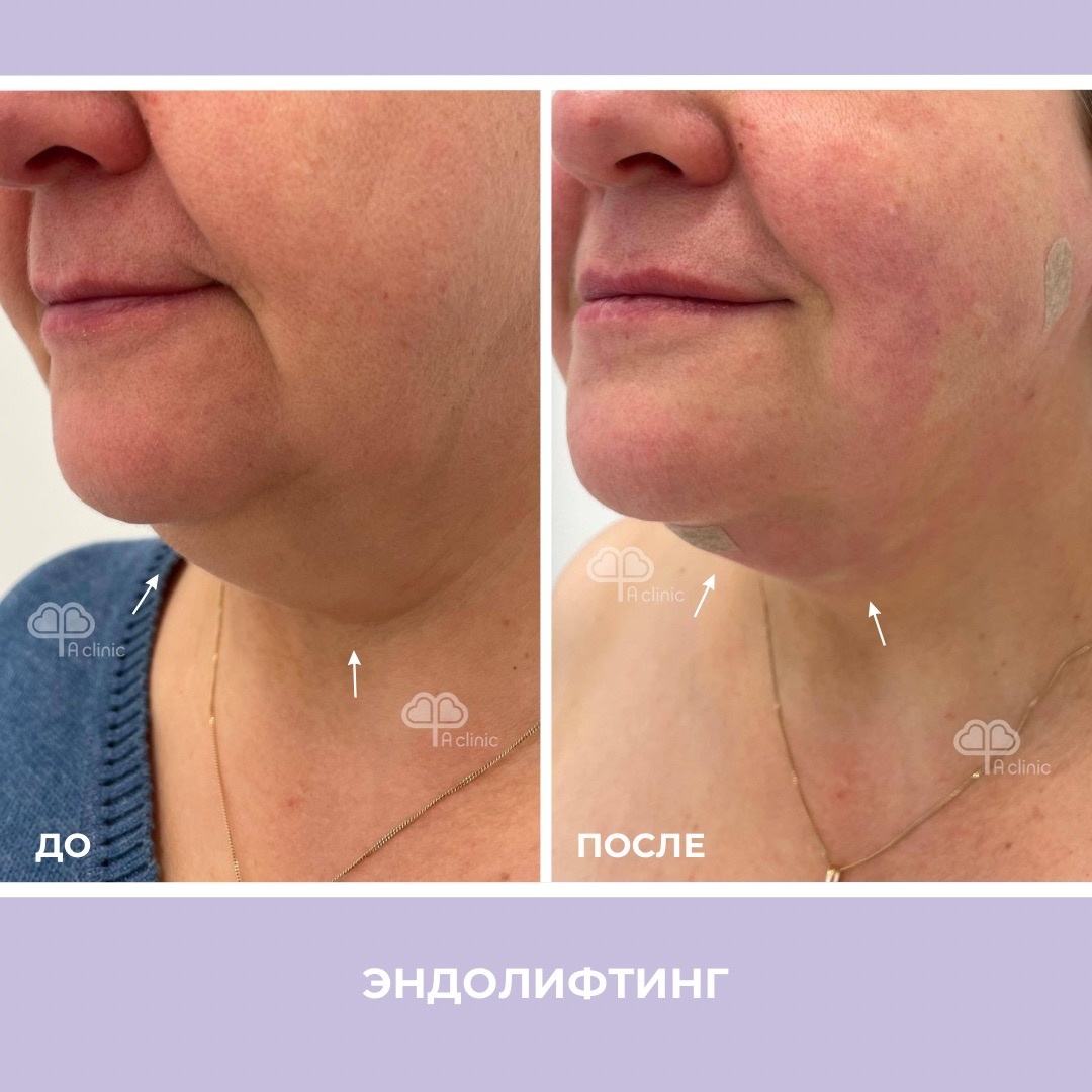 Эндолифтинг. А Клиника